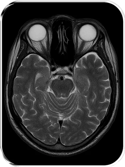 brain MRI